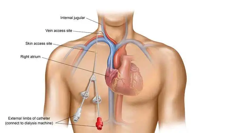 Dialysis Catheter Insertion