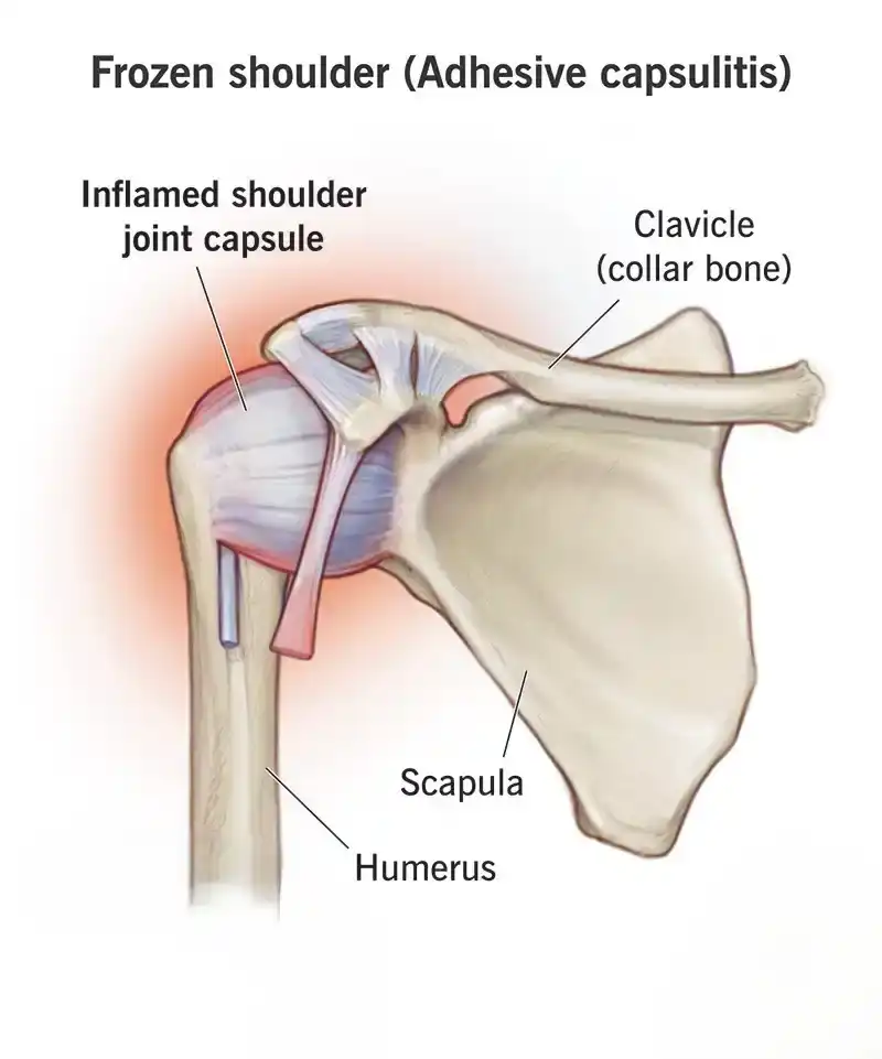 Frozen Shoulder (Adhesive Capsulitis)